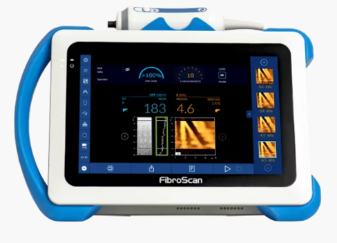 Fibroscan